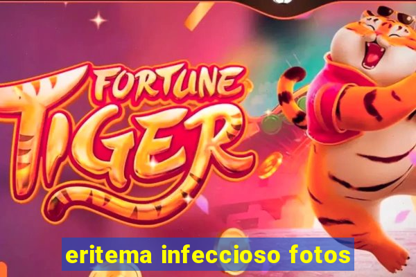 eritema infeccioso fotos